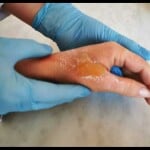 burn from fireworks