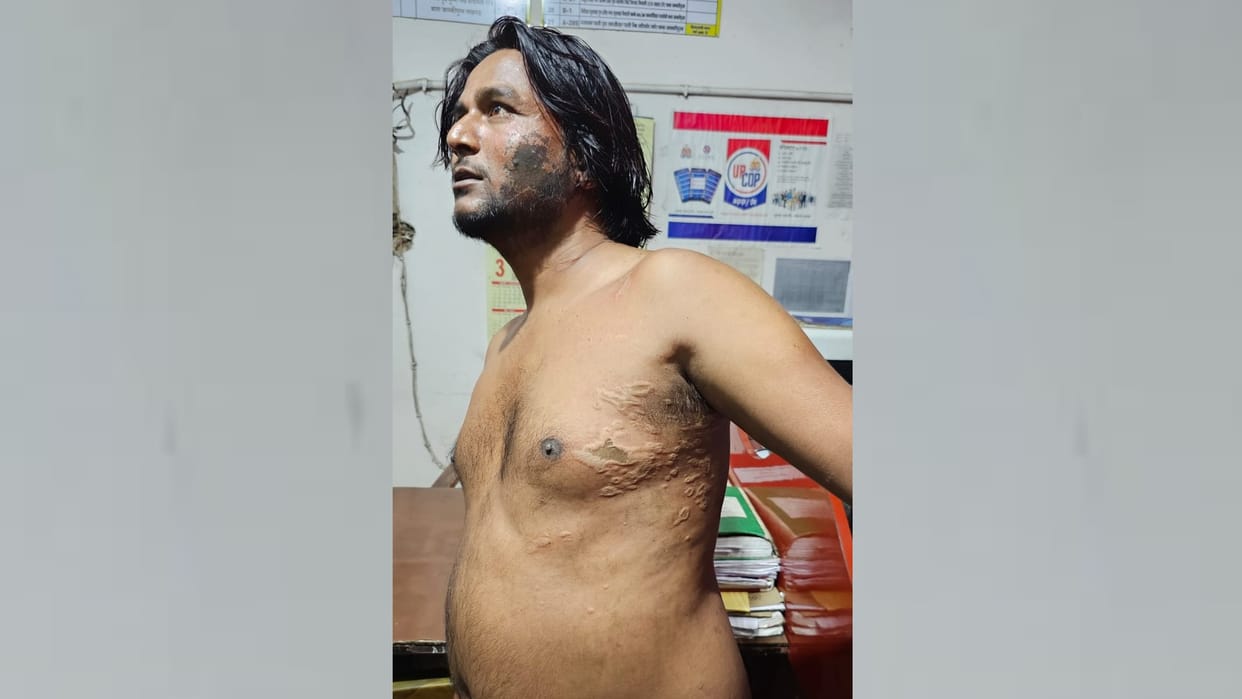 Acid aatack in Jankipuram in Lucknow.