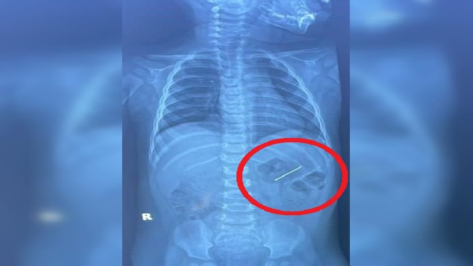Nine month old child swallows Alpin in Noida removed through endoscopy