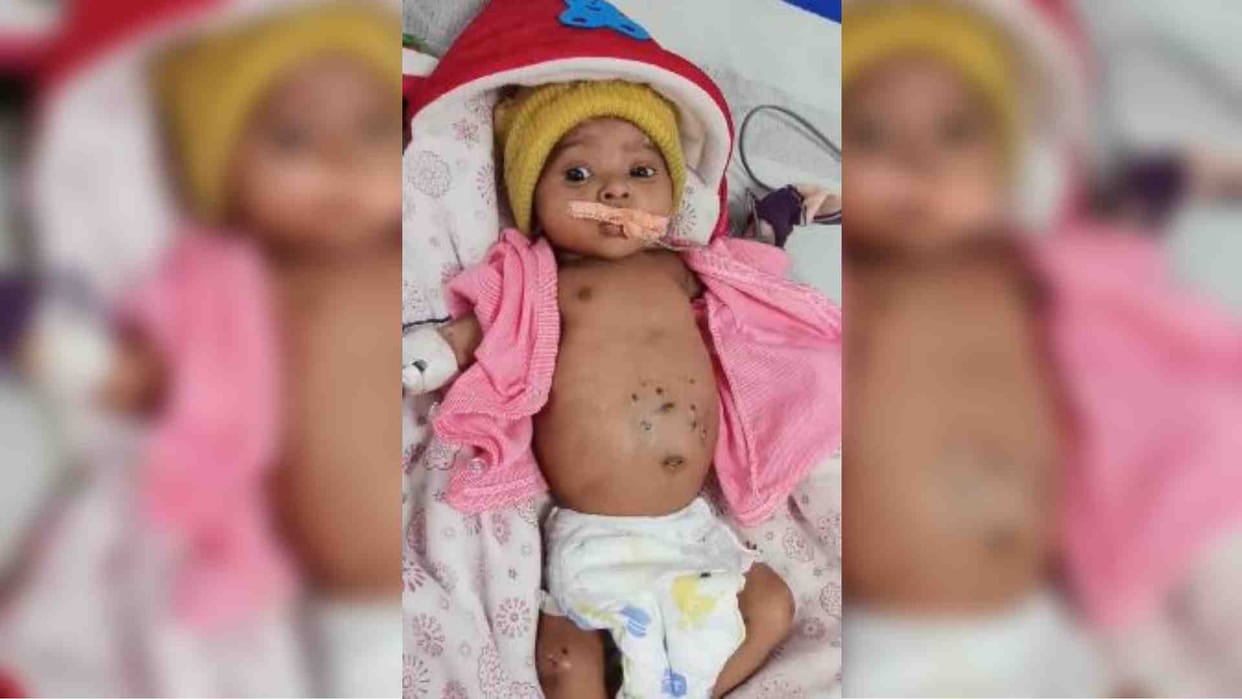 Innocent child burnt with hot rods in Shahdol