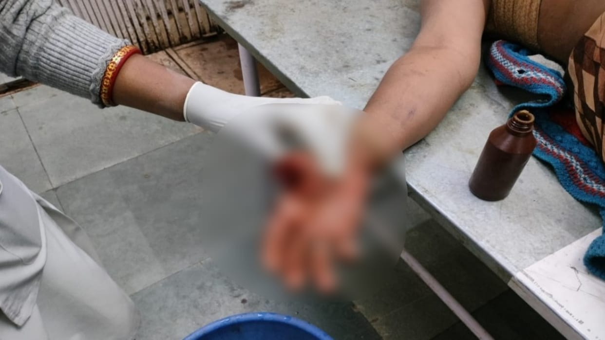 Damoh brother-in-law bit the thumb of sister-in-law hand In Karondi village