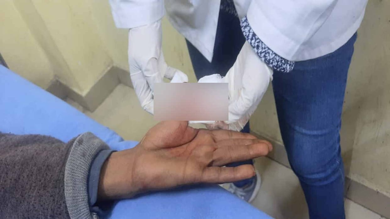 Stray dog bites five people, badly injured woman referred to PGI