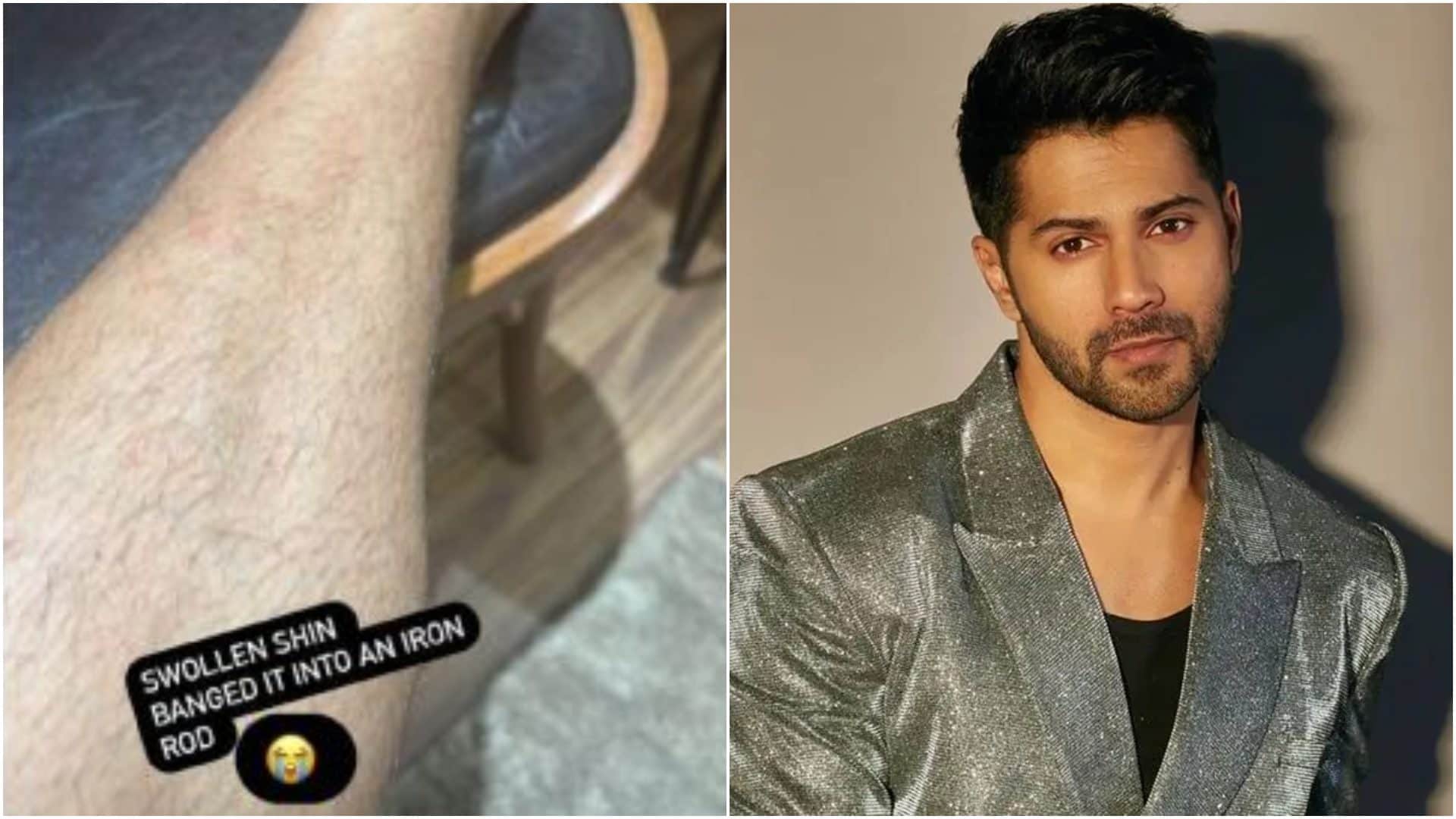Varun Dhawan suffers Injures once again while shooting for Atlee upcoming movie VD 18 shares swollen leg photo