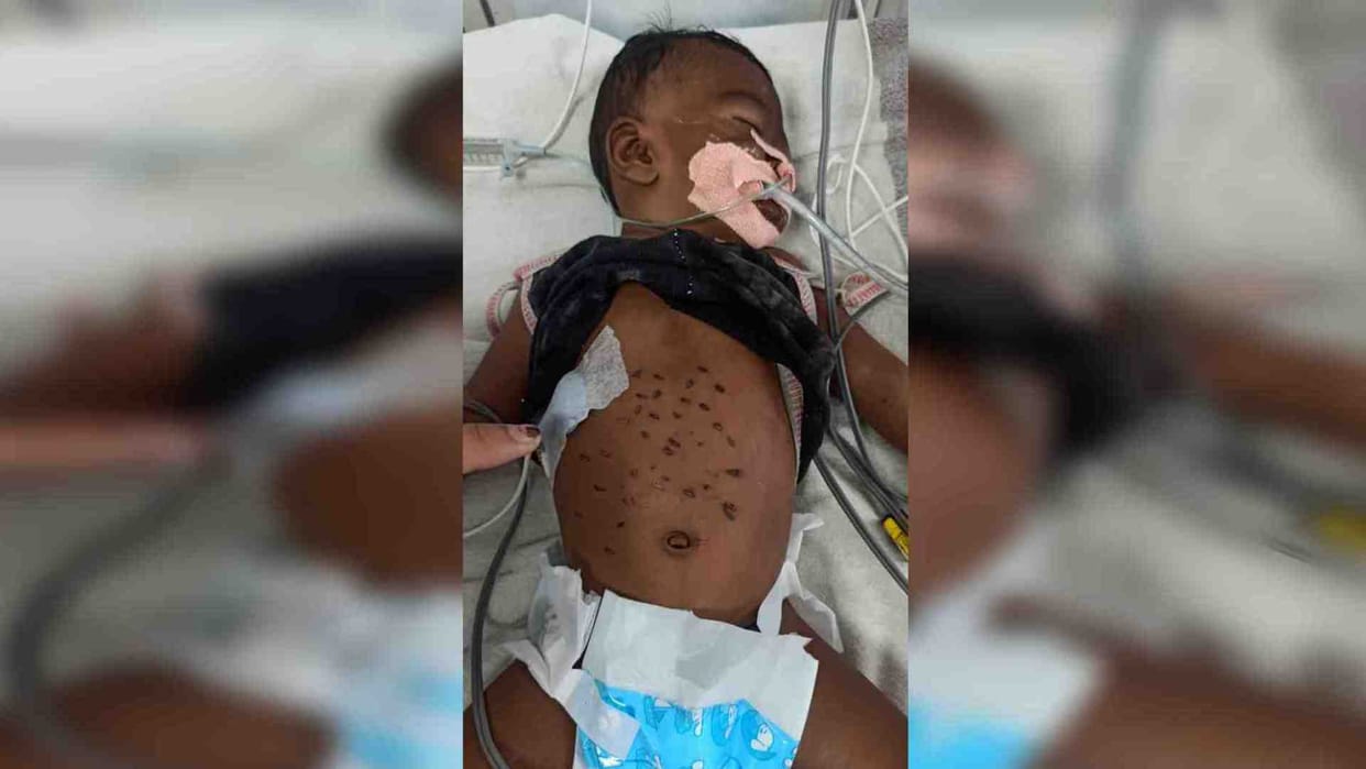 In Anuppur, a three-month-old girl was stabbed 51 times with hot rods