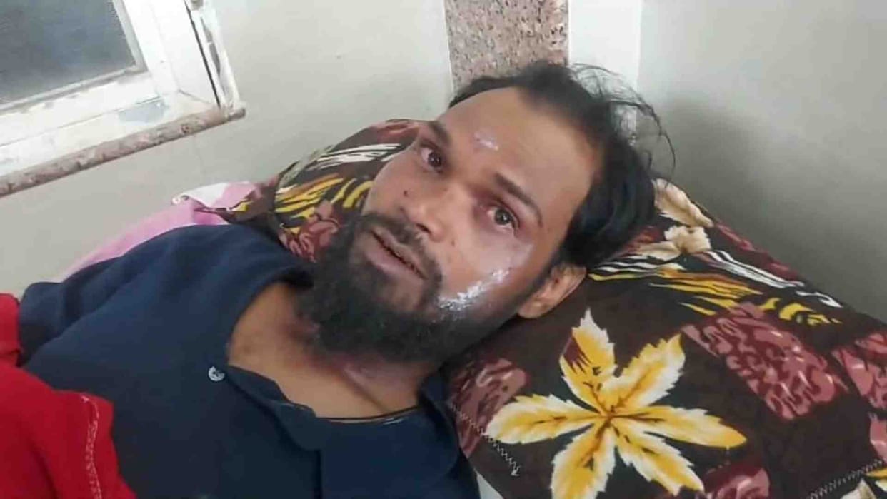 Youth burnt due to kerosene stove explosion while cooking in Damoh