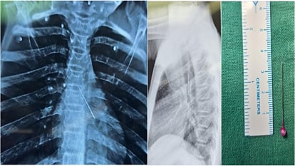 SN Medical College Doctors Save Girl Exited Pin From Breathing Tube