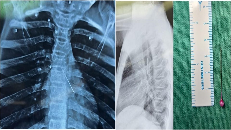 SN Medical College Doctors Save Girl Exited Pin From Breathing Tube
