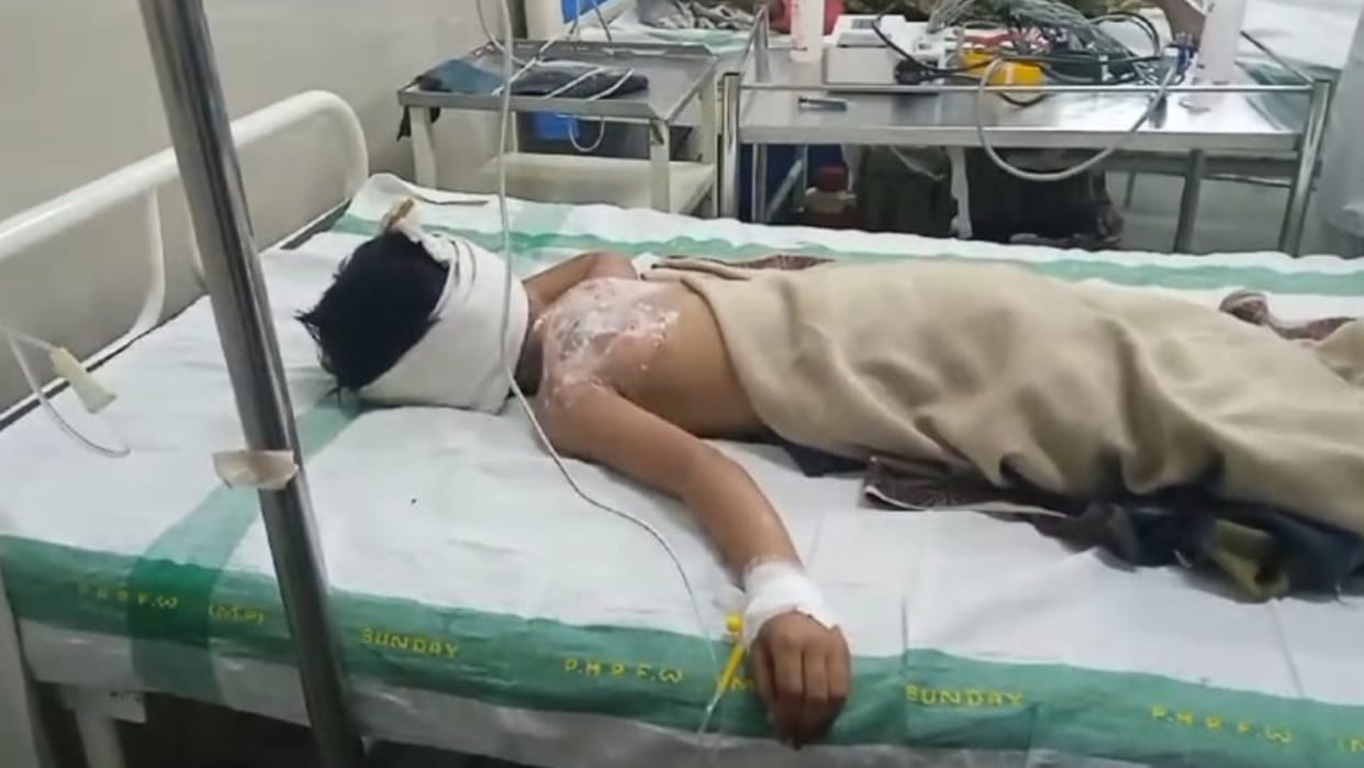 Innocent child burnt by lamp in Chhindwara