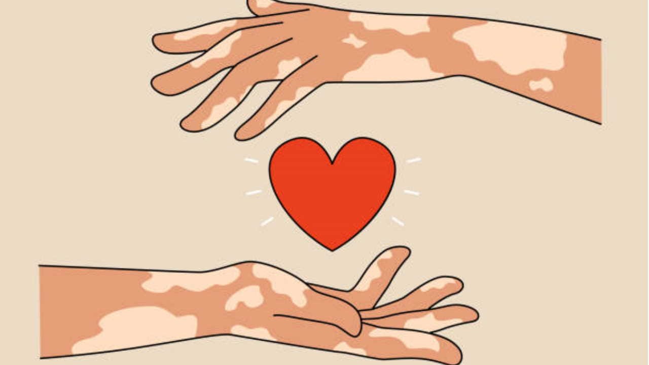 world leprosy day 2024 know myths and facts about leprosy in hindi