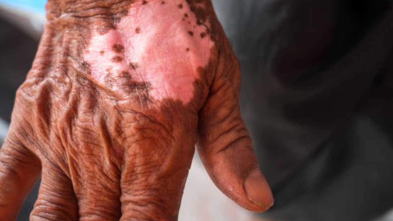 world leprosy day 2024 know myths and facts about leprosy in hindi