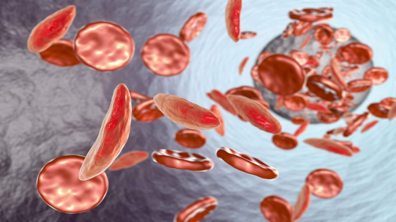 medicine to prevent sickle cell disease what is sickle cell disease and its risk in india