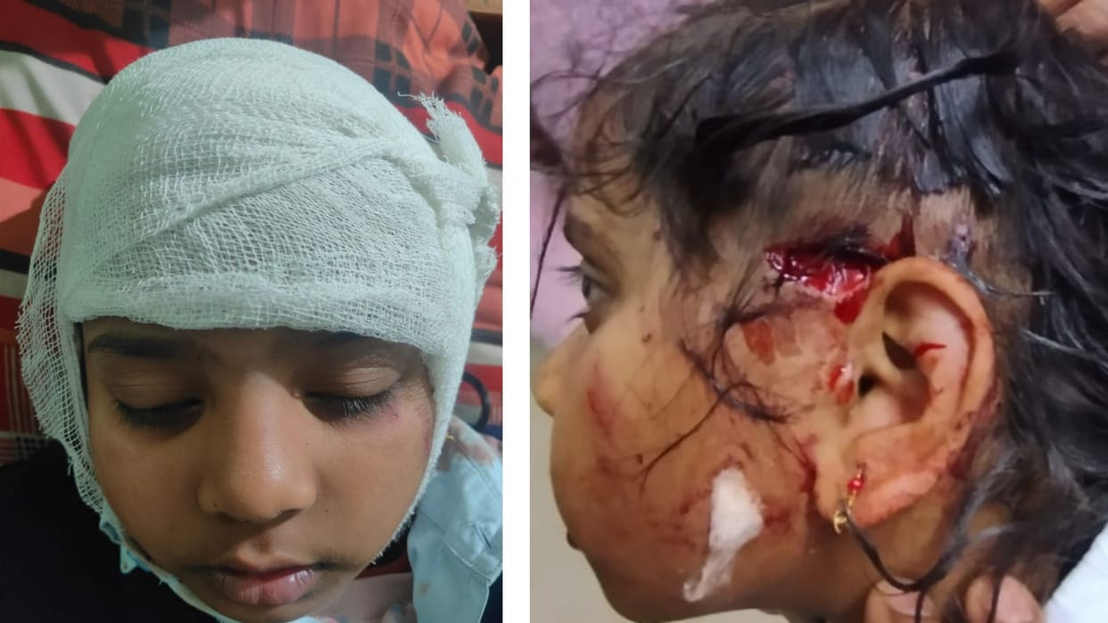 Girl bitten by dog in school, case filed against three