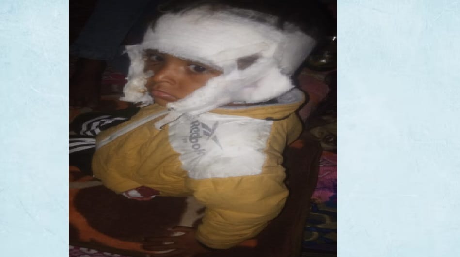 Pitbull attacked two year old innocent child. Incident happened in front of owner in Amroha