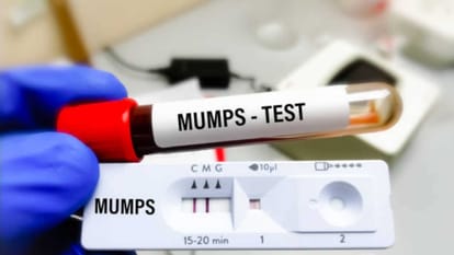 mumps infection outbreak in delhi ncr know mumps symptoms and risk factors
