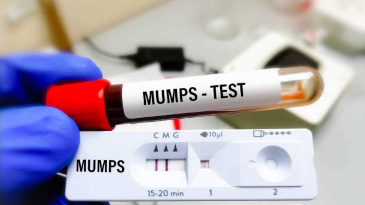 mumps outbreak 2024 in india what causes mumps infection and its complications in hindi