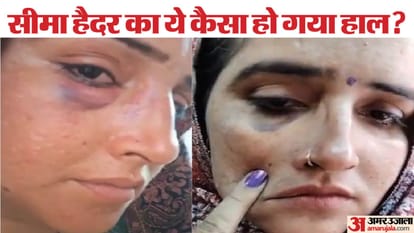 Seema Haider showed injury marks on her face