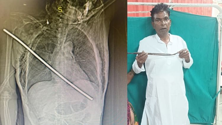 दिल के आर-पार हो गई थी सरिया: डॉक्टरों ने बचा ली जान, दावा- इस तरह के मामले में जान बचाने का पहला मामला