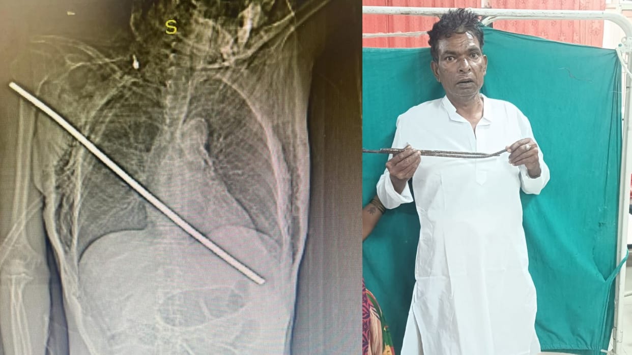 KGMU doctors saved life of a critical patient in Lucknow.