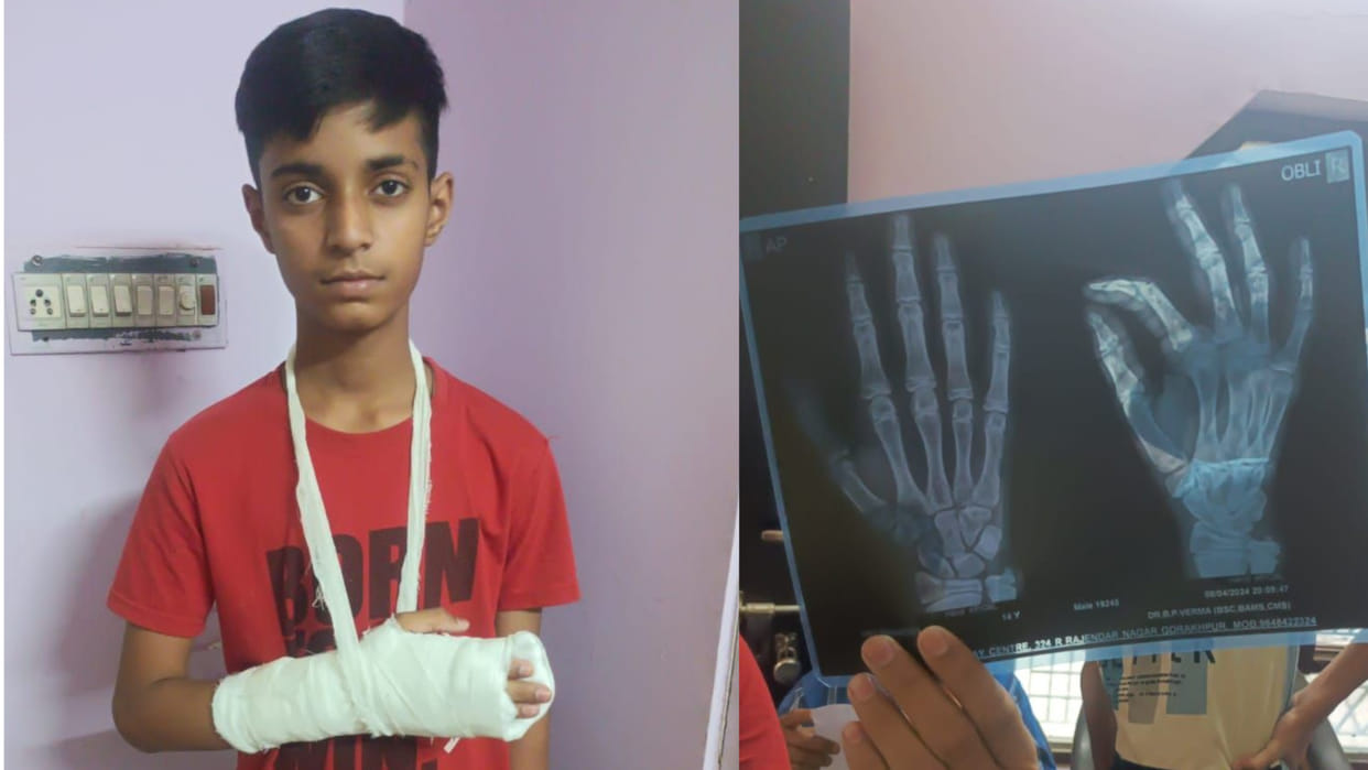 Teacher beats...fourth class student's fingers broken in gorakhpur