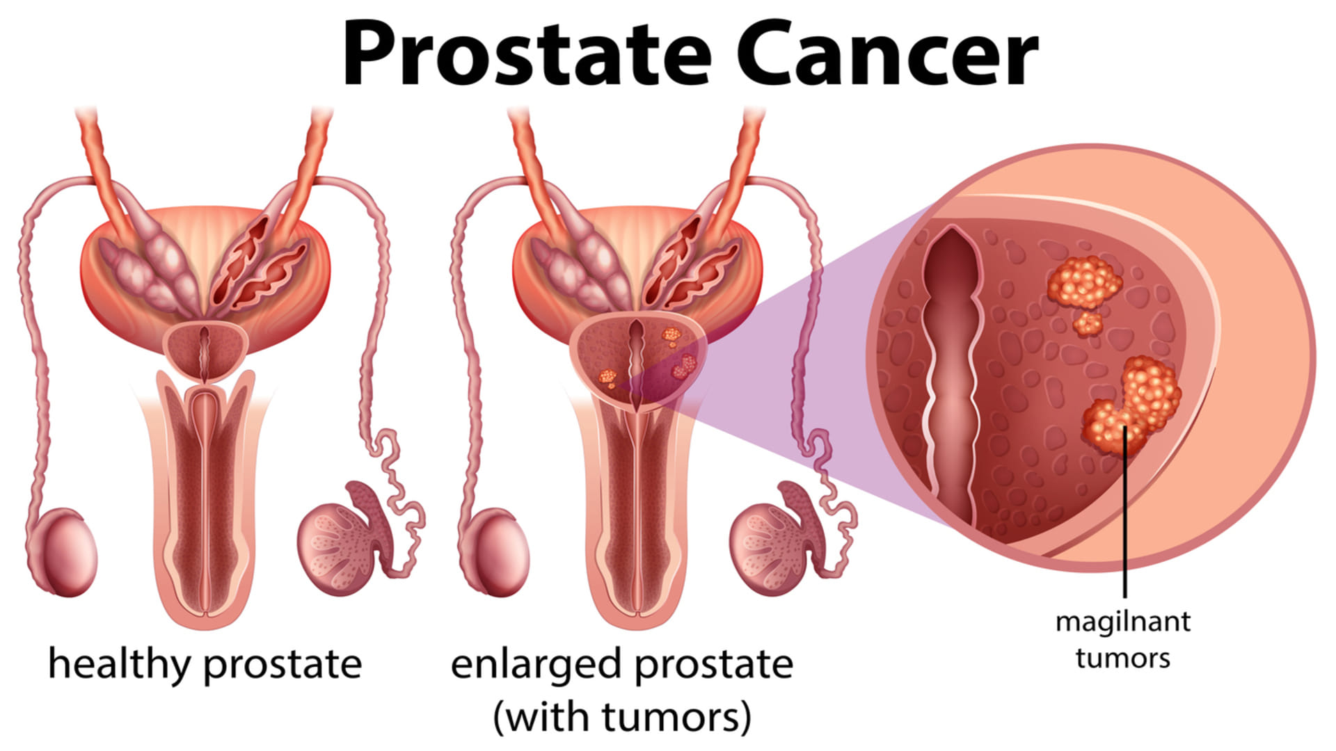 screening trial to early diagnose prostate cancer TRANSFORM trial the biggest prostate cancer screening