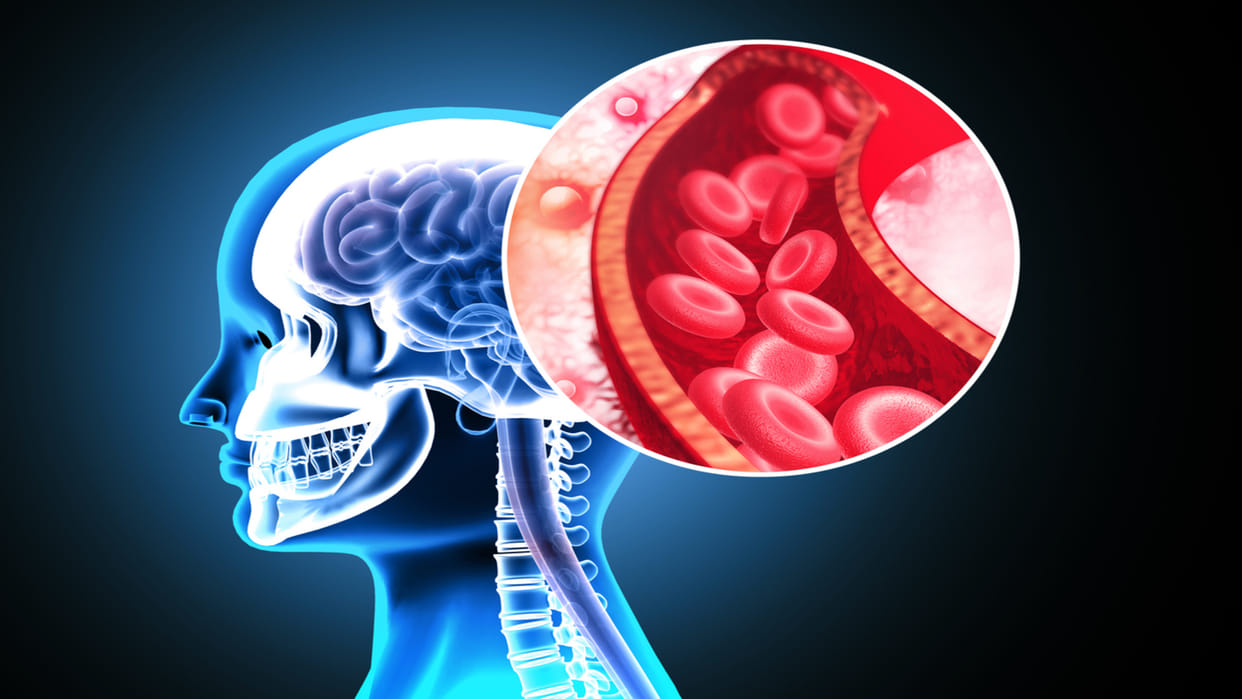 stroke cases worldwide in young adults know its symptoms and prevention