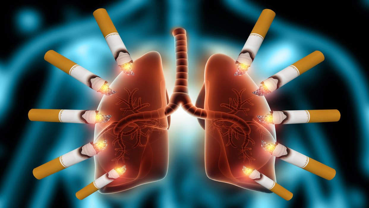 lungs cancer stages and risk know Lung Cancer Among People Who Never Smoked in hindi