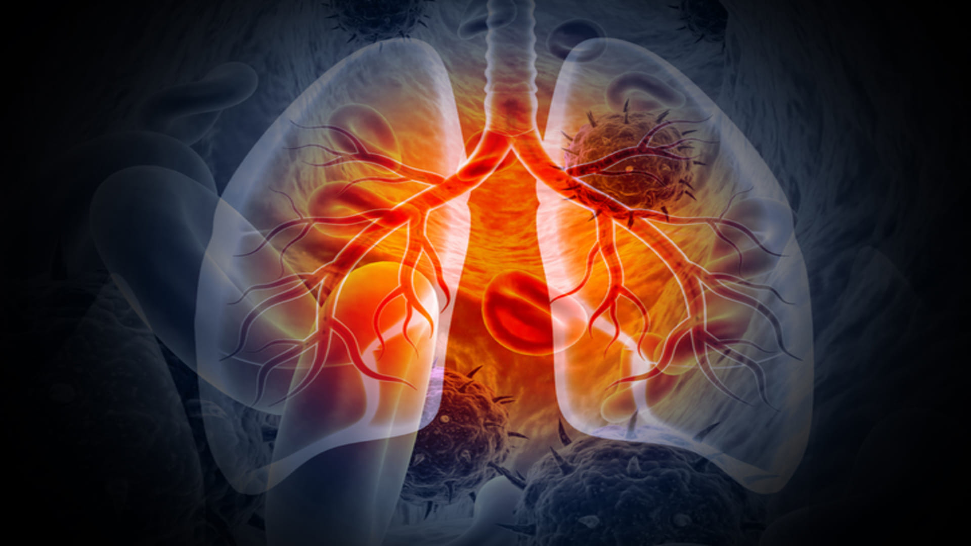 lungs cancer stages and risk know Lung Cancer Among People Who Never Smoked in hindi
