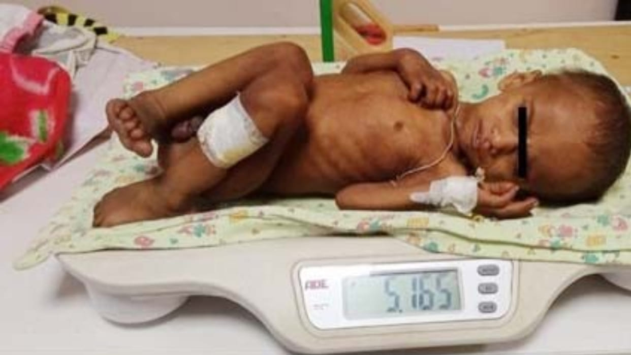 Bhopal: A 13-month-old child was suffering from severe malnutrition, TB and anemia, doctors gave him new life