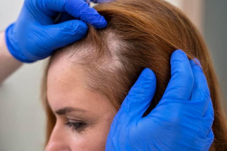 alopecia areata nearly doubled in people who had a COVID infection latest study says