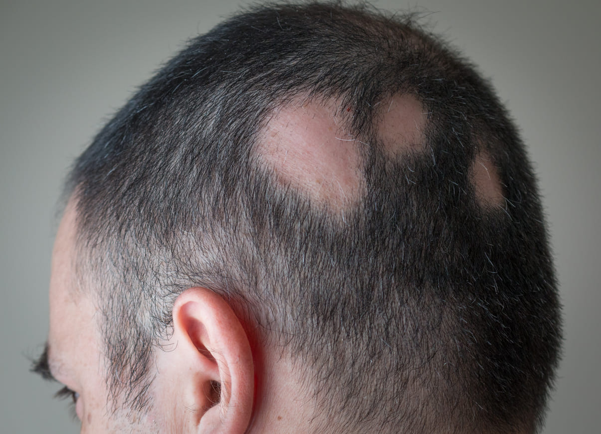 alopecia areata nearly doubled in people who had a COVID infection latest study says