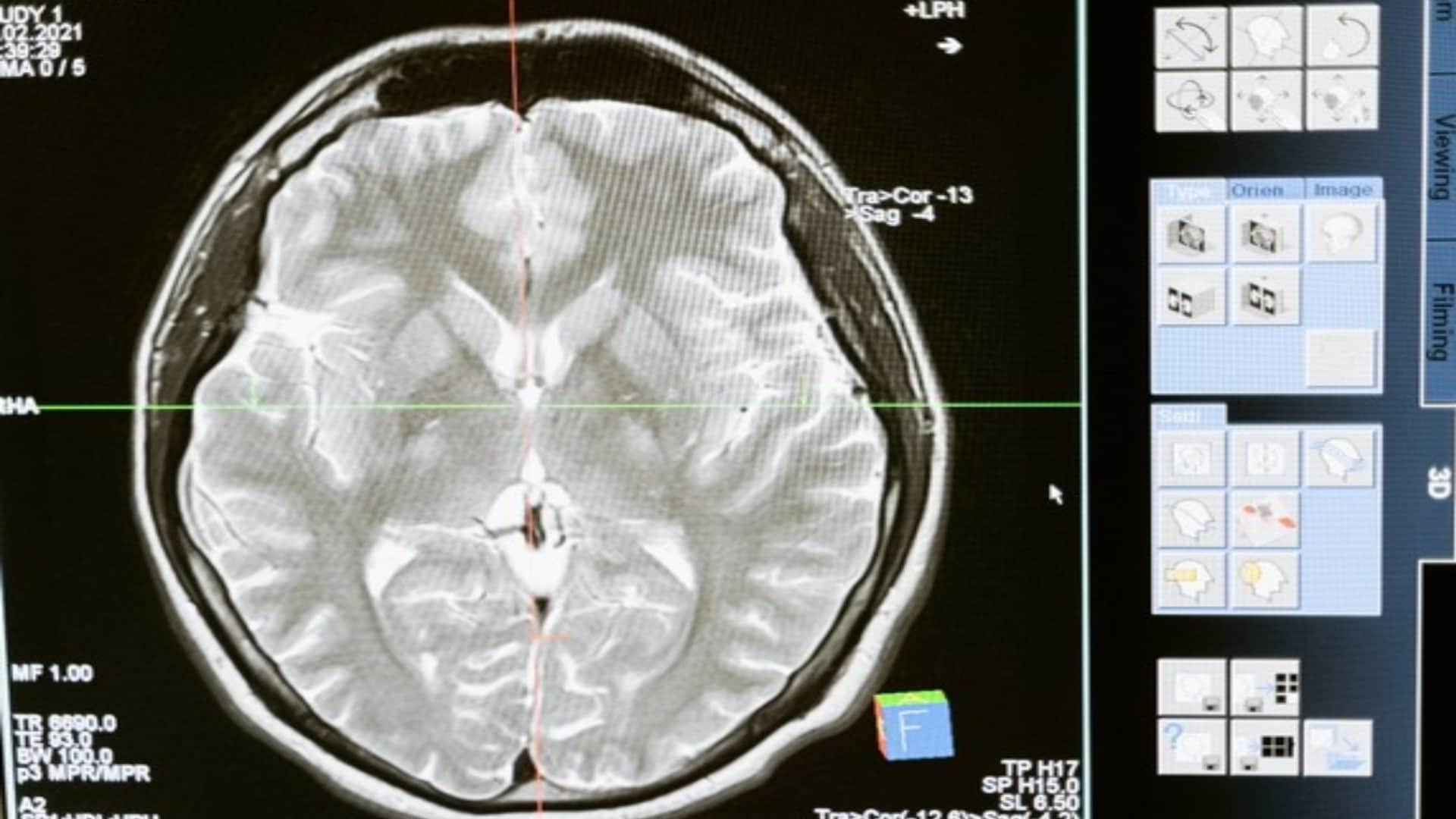 world brain tumor day 2025 Know Causes Symptoms and Prevention Tips of tumor in brain