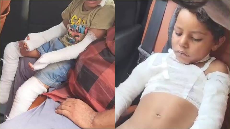 two children got burnt due to fire in their hut caused by the burning of garbage In Khurja