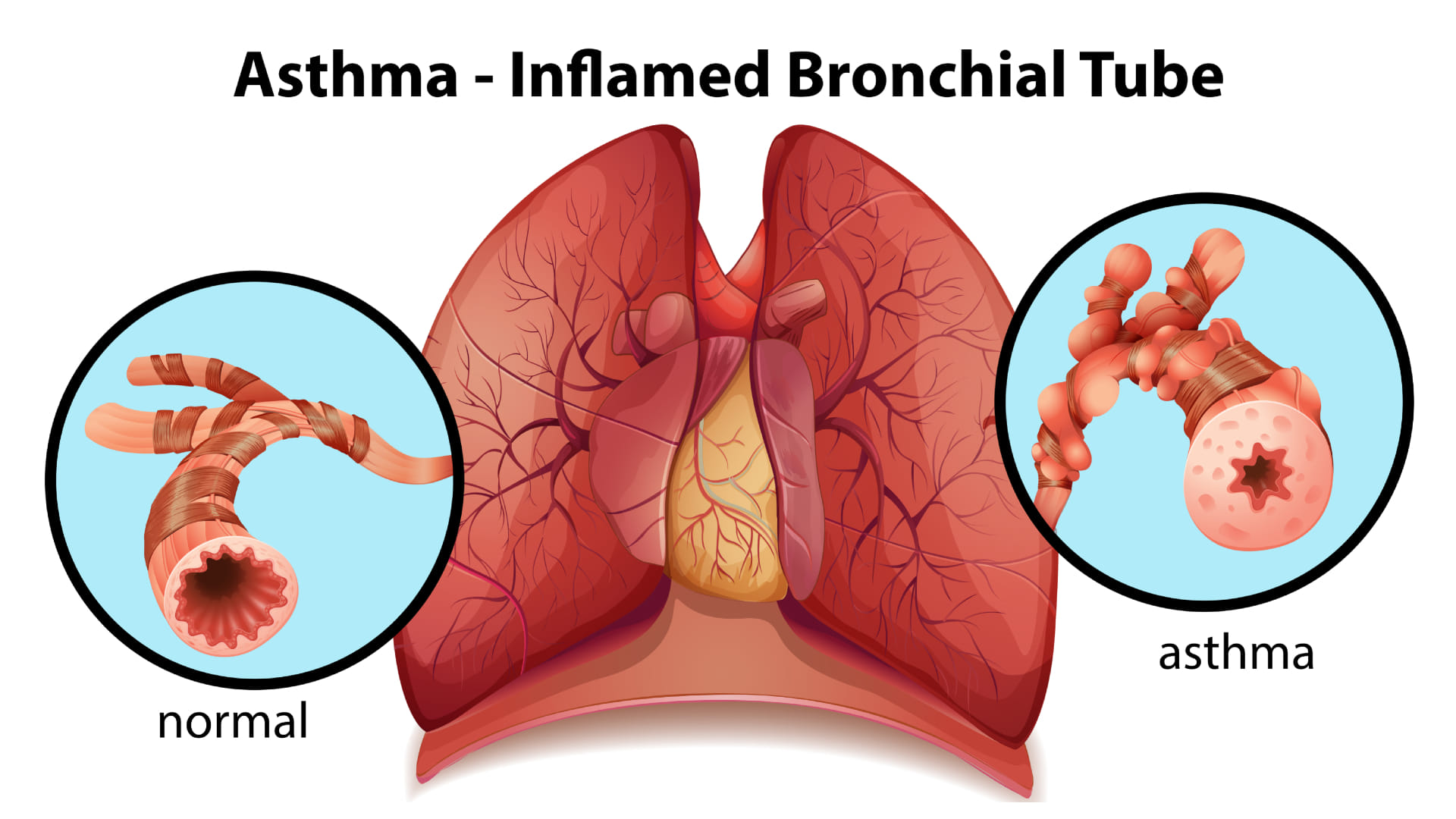 World Asthma Day 2024 hot air exposure can be very problematic for asthma patients