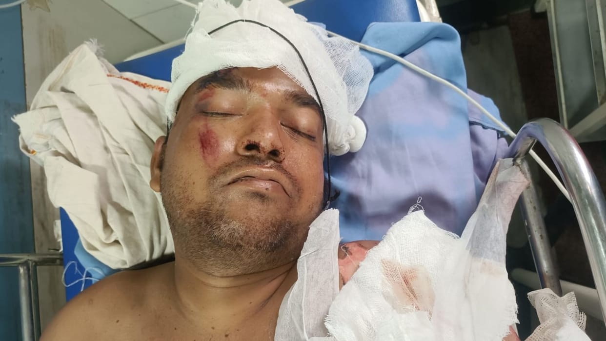 Lineman burnt due to electric shock in Chandauli