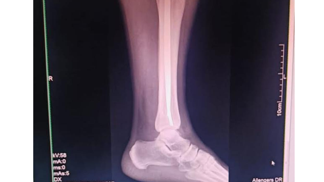 Indore: After two operations in two days, doctors saved a seven-year-old child's leg from being amputated