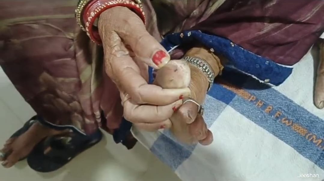 छिंदवाड़ा जिला अस्पताल में मरीज के पैर चूहे ने कुतर दिए।
