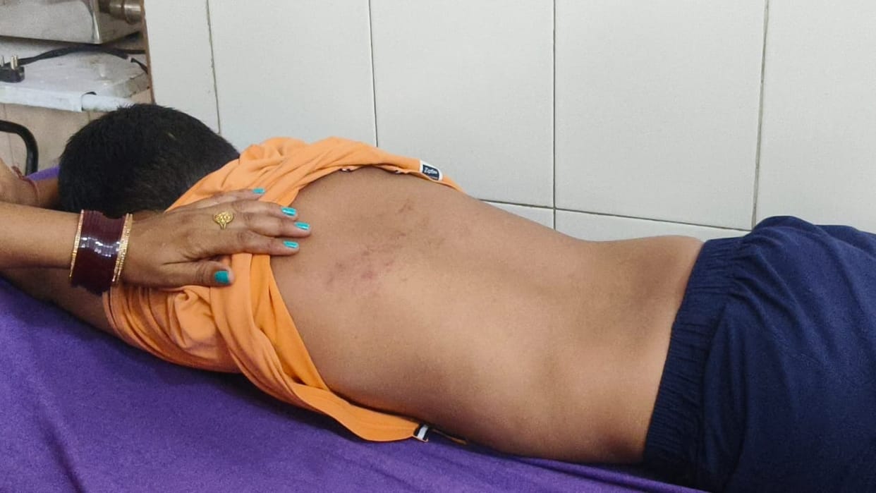 Principal of private school beats child badly, admitted in Hansi Civil Hospital