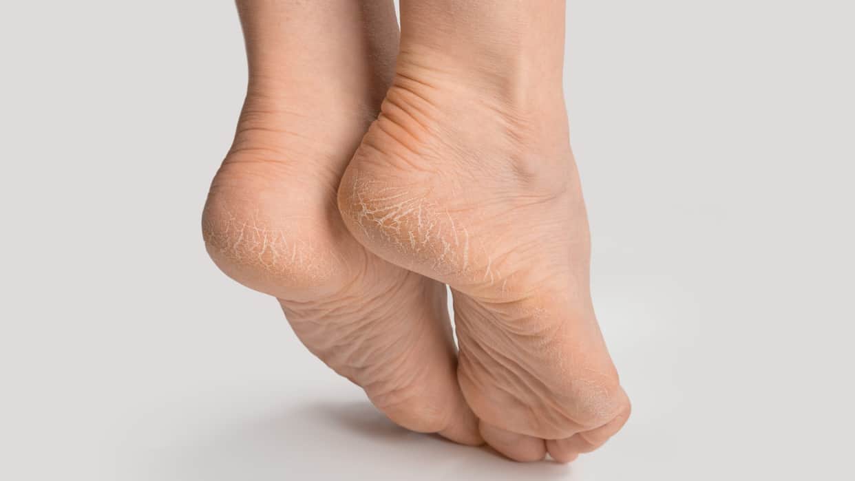 Cracked Heel Care in summer how to treat crack heels at home in hindi