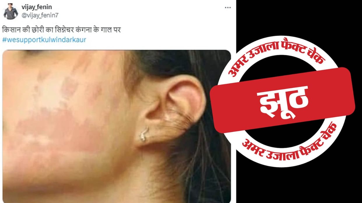 Viral picture claiming to be a slap mark on Kangana Ranaut's cheek is not real