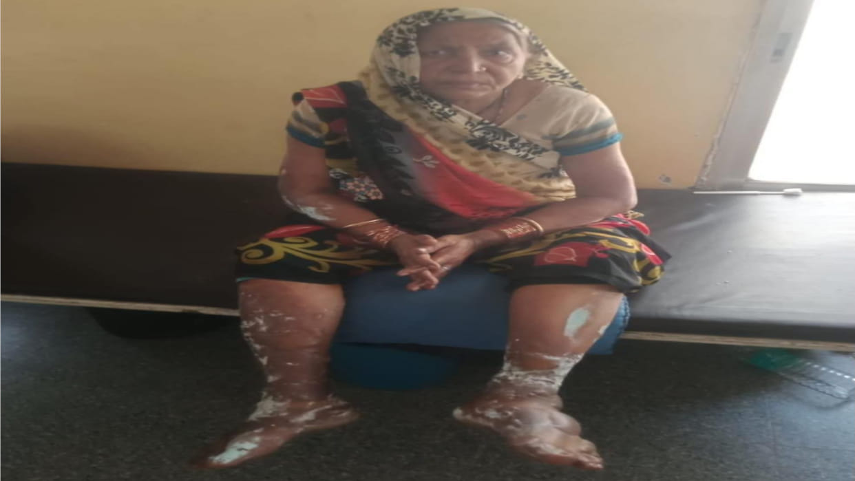 Gas cylinder caught fire due to leakage, couple burnt in Gorakhpur