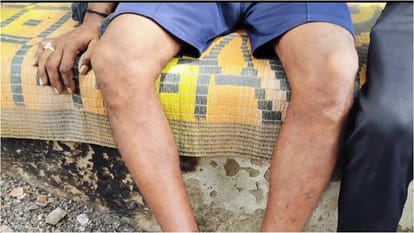 Bihar News : Third degree of bihar police in Bhagalpur, six people got treatment in hospital