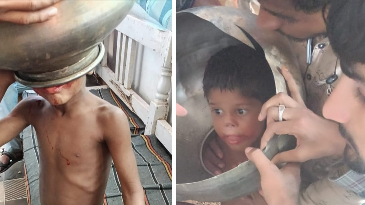 Vidisha: Five year old Sajid's head was stuck in a steel grate for an hour, it was removed with a cutter.