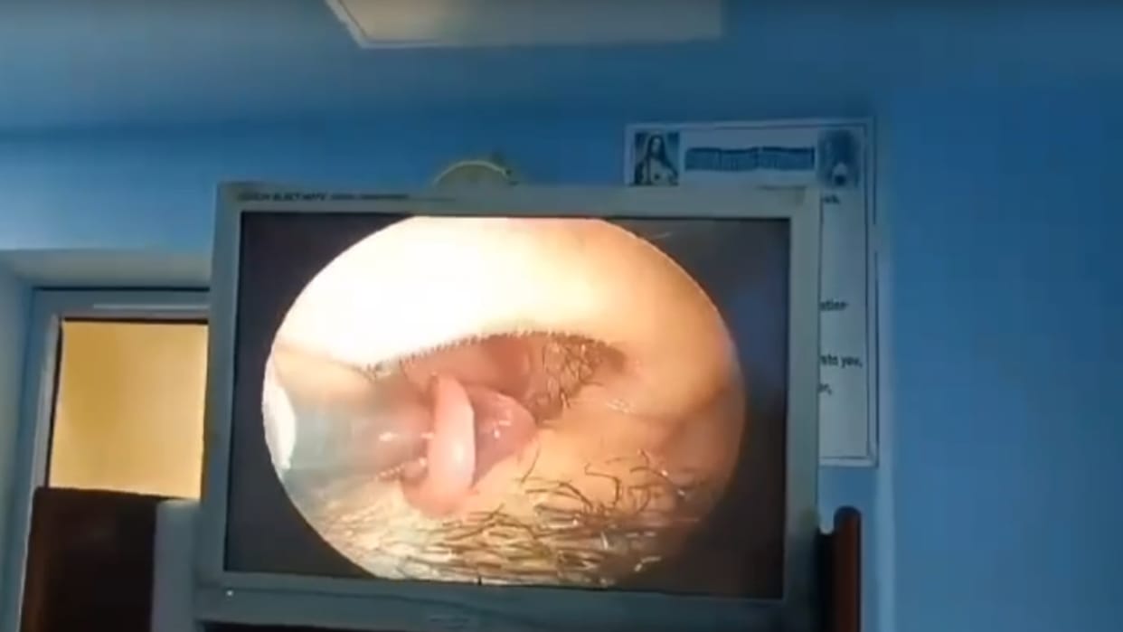 Doctors removed the leech that had entered the nose through binoculars. The leech had entered the nose while b