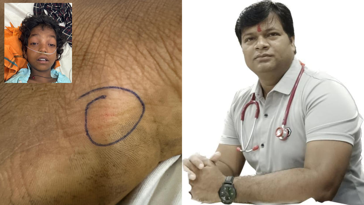 Shahdol News: Snake bite marks on foot in torch light, doctor saved girl's life