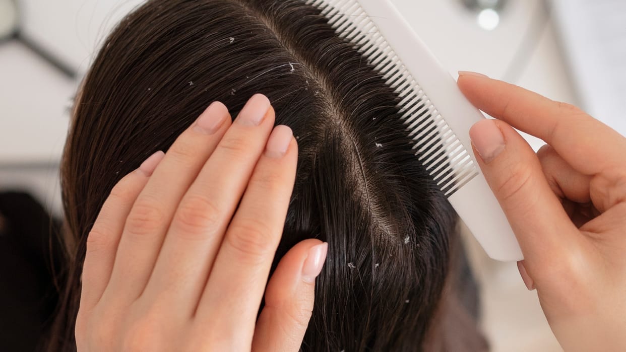 Lice Removal Tips in hindi bigg boss ott 3 shivani kumari gets hair lice
