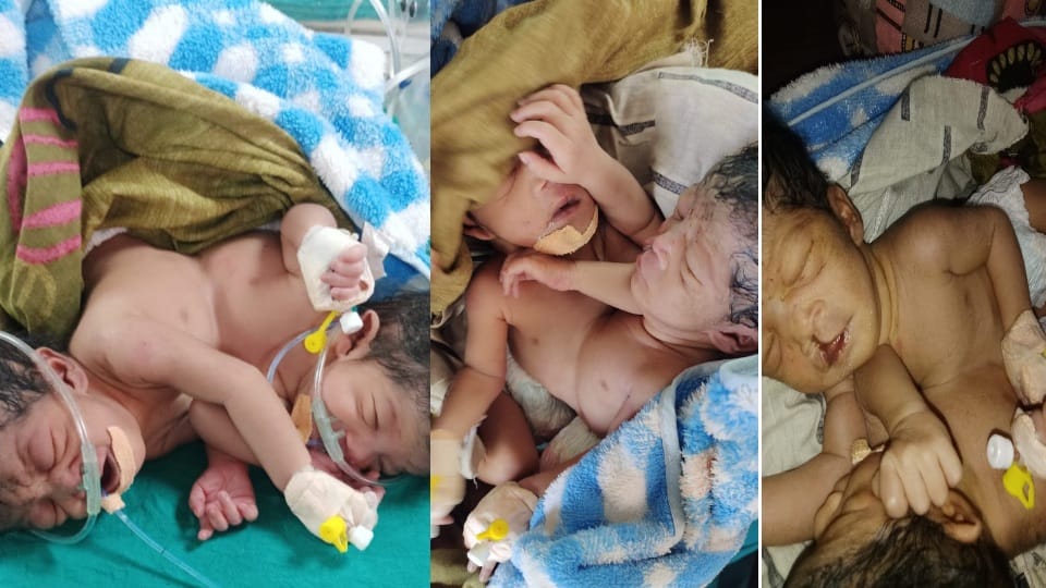 Twin girls born in Ambala hands legs and head separate one heart beating in both