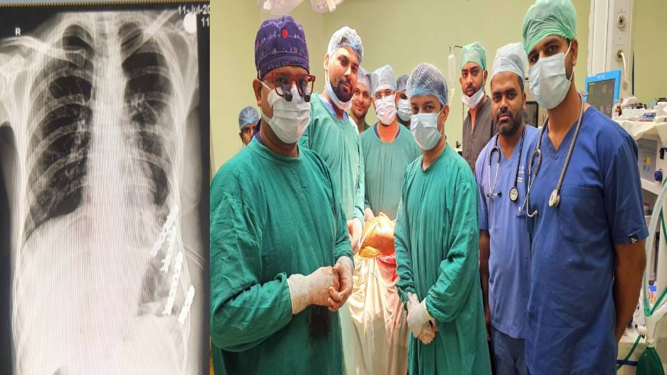 Doctors of SN Medical College saved life of shoemaker by performing complicated operation in Agra