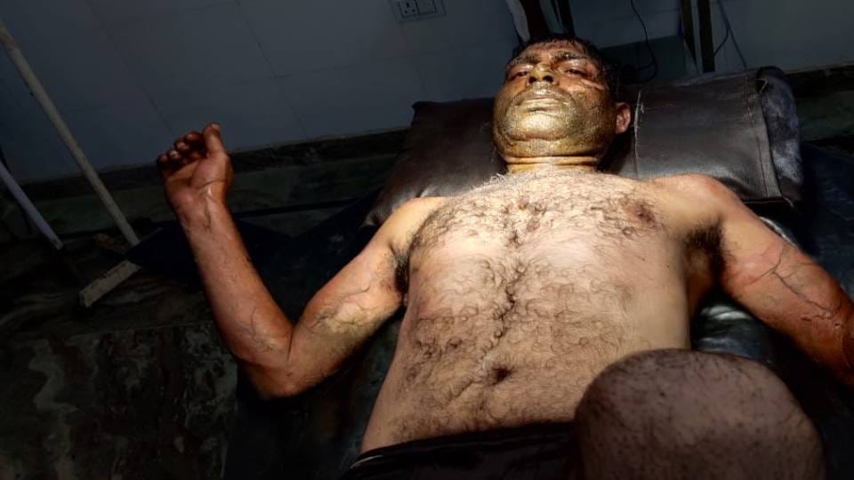 dispute between brothers over division of property In Agra elder one poured petrol on himself and fire