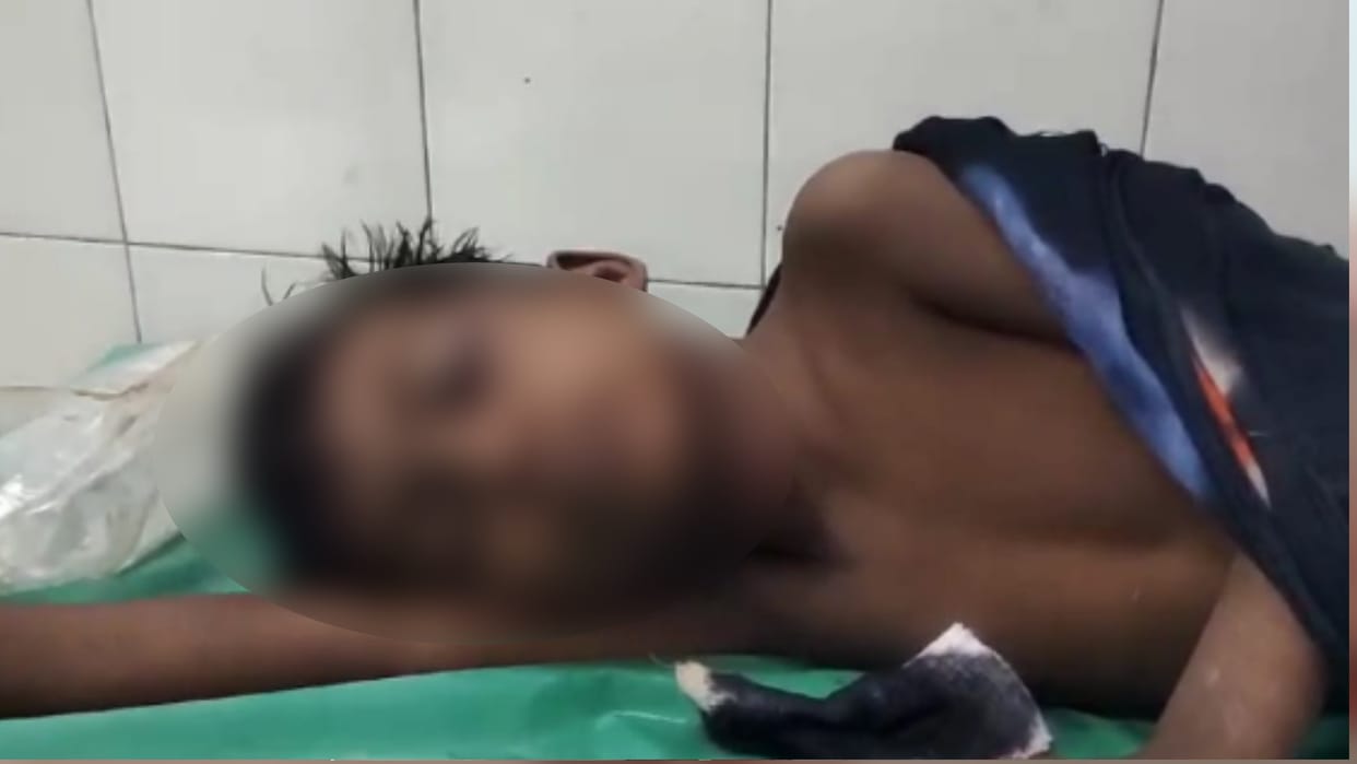 Factory worker's stomach filled with air from compressor pipe admitted to hospital in critical condition