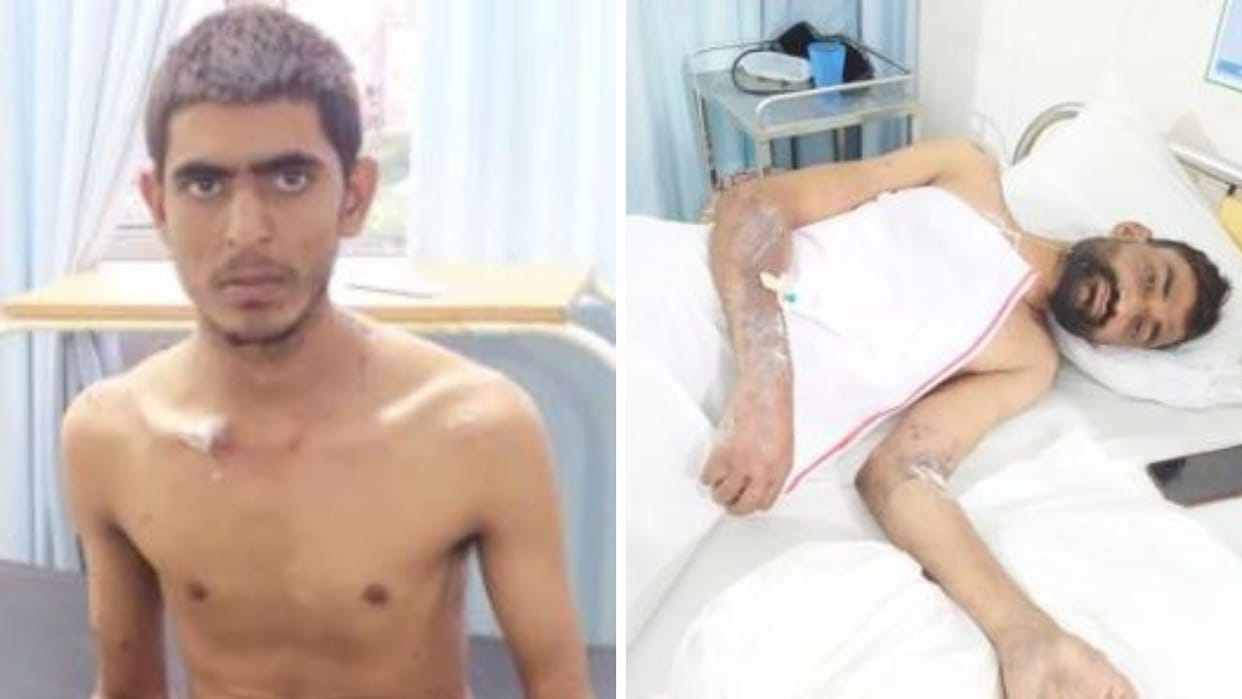 Solan News Four workers were burnt due to explosion in iron industry case registered against the company